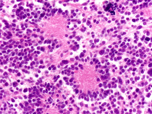 Neuroblastoma